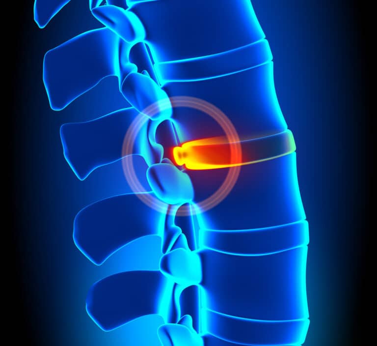 Bulging Disc Vs Herniated Disc Whats The Difference Hamid R Mir Md 