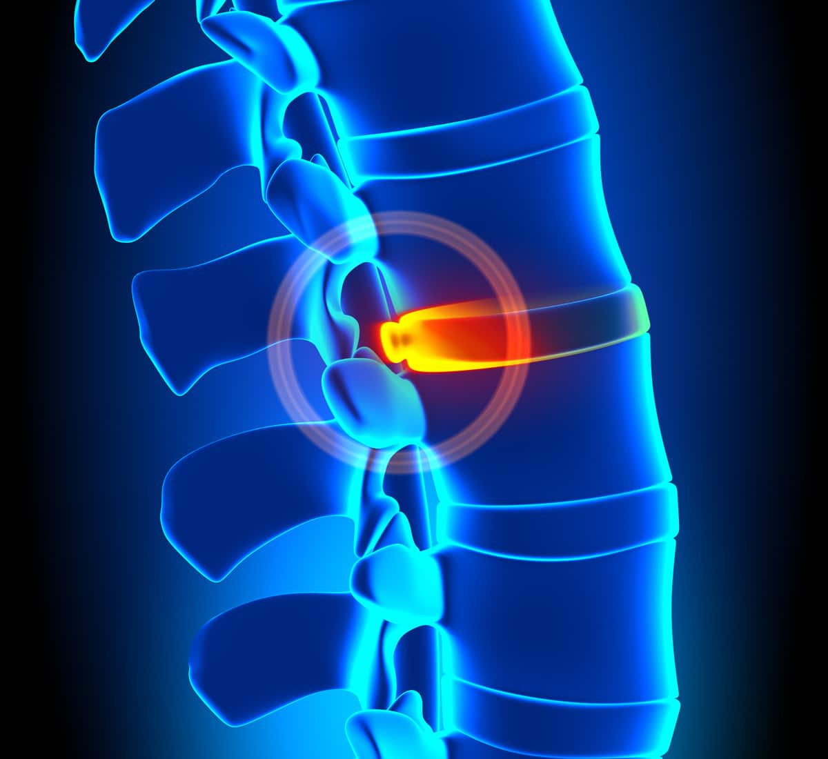 Key Differences Between a Herniated and Bulging Disc a sufferer in