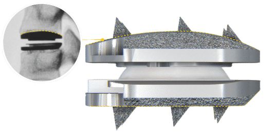 Types of Artificial Disc Replacement